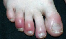 Xử trí sưng đỏ do cước tay chân