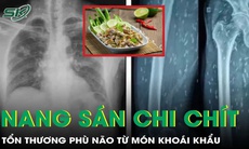 Tổn thương phù não gây co giật, méo miệng vì nang sán chi chít khắp cơ thể