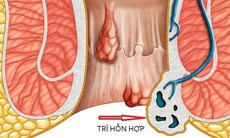 Khi nào người bệnh trĩ cần đến bệnh viện?