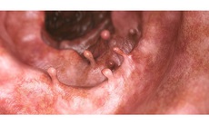 Polyp đại tràng có phải cắt không?