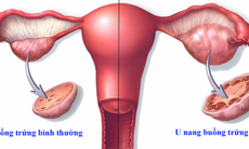Phụ nữ cần đi khám phụ khoa định kỳ để phát hiện căn bệnh nguy hiểm, ít triệu chứng này
