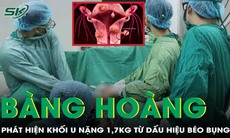 Tưởng béo bụng, đi khám bàng hoàng phát hiện khối u nặng 1.7kg, chiếm trọn ổ bụng