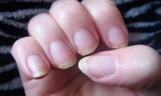 5 dấu hiệu phổ biến cảnh báo thiếu hụt vitamin và khoáng chất thiết yếu