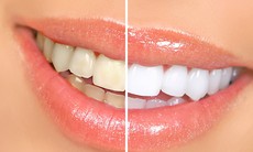Bí quyết để giữ trắng răng bền lâu sau khi tẩy trắng