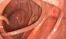 Các thói quen khiến bạn dễ mắc giun đũa và cách phòng ngừa