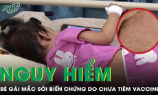 Bé gái 29 tháng tuổi mắc sởi biến chứng viêm phổi do chưa tiêm vaccine