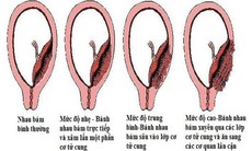 Bác sĩ vượt 100km cứu sản phụ rau cài răng lược nguy kịch