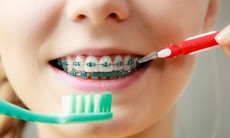 Một số lưu ý khi niềng răng để hàm răng luôn trắng khoẻ