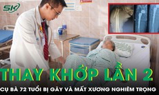 Thay khớp gối lần 2 cho cụ bà 72 tuổi bị gãy xương và mất xương nghiêm trọng