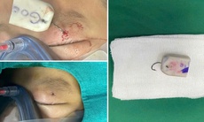 Bé trai 8 tuổi bị móc câu móc vào mi mắt khi đi câu cá cùng gia đình