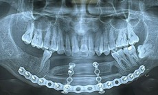 Tìm lại nụ cười bằng cấy ghép implant trên xương mác