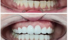 Những lưu ý khi bọc răng sứ