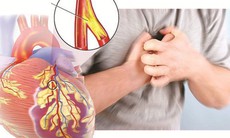 Bệnh mạch vành gây biến chứng nguy hiểm