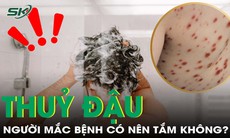 Bị thủy đậu có nên tắm? Sự thật khiến nhiều người bất ngờ