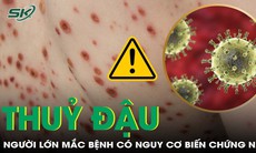 Người lớn mắc thủy đậu: Nguy cơ biến chứng nặng nếu không được điều trị đúng