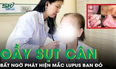 Giảm 14 kg trong nửa năm, người phụ nữ bàng hoàng phát hiện mắc lupus ban đỏ