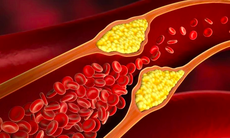 Hẹp động mạch cảnh: Nguyên nhân, biểu hiện, cách điều trị và phòng bệnh