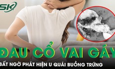 Đi khám đau cổ vai gáy kéo dài, người phụ nữ bất ngờ phát hiện mắc u quái buồng trứng