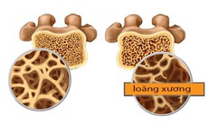 Những điều nên và không nên làm khi bị loãng xương
