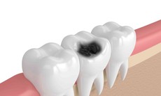 Sâu răng không được chủ quan, cách chữa thế nào?