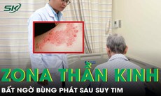 Người phụ nữ bất ngờ bùng phát zona thần kinh sau suy tim