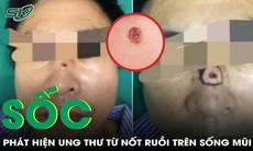 Nốt ruồi trên sống mũi tưởng may mắn, người đàn ông sốc khi phát hiện ung thư