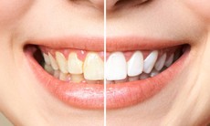 Răng ố vàng làm sao cho trắng?