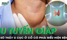 Sờ thấy u cục ở cổ có thể là biểu hiện của u tuyến giáp?