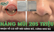 Nâng mũi 10 triệu bị 'thổi giá’ lên 205 triệu nhận cái kết mũi sưng đỏ, cứng như đá