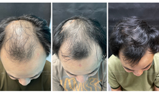 Xu hướng điều trị rụng tóc mới năm 2025