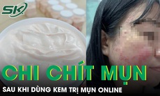 Mặt mụn chi chít, nguy cơ sẹo vĩnh viễn sau khi dùng kem trị mụn online