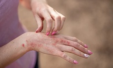 Bệnh gai đen: Nguyên nhân, biểu hiện, cách điều trị và phòng bệnh