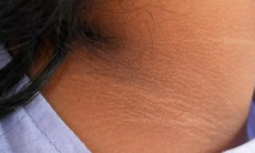 Câu hỏi thường gặp liên quan đến bệnh gai đen