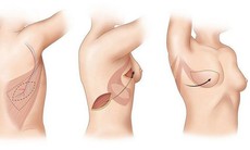 Tái tạo vòng 1 - biện pháp giúp chị em tự tin sau điều trị ung thư vú