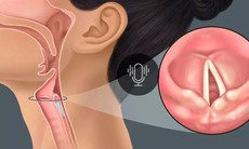 Câu hỏi thường gặp liên quan đến bệnh lao thanh quản