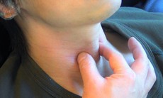 Câu hỏi thường gặp liên quan đến bệnh liệt cơ mở thanh quản