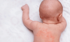 Cách phân biệt phát ban do sởi và phát ban thông thường