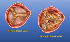 Một số câu hỏi thường gặp về hẹp van động mạch chủ