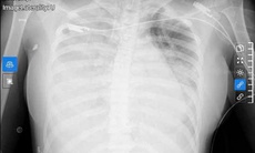 Chỉ với triệu chứng như cảm cúm, nữ sinh được phát hiện nhiễm liên cầu khuẩn nhóm A nguy kịch