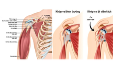 Một số thuốc dùng trị viêm quanh khớp vai