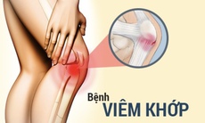 Viêm khớp: Nguyên nhân, triệu chứng, cách điều trị và phòng ngừa
