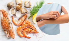 Đi du lịch biển, cần chú ý 6 loại hải sản dễ gây dị ứng nhất