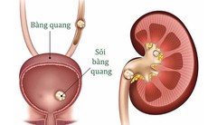 Sỏi bàng quang có nguy hiểm?