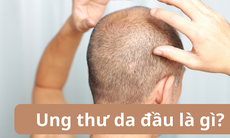 Ung thư da đầu: Nguyên nhân, triệu chứng, cách điều trị và phòng bệnh