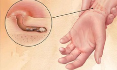 Câu hỏi thường gặp liên quan đến bệnh ghẻ