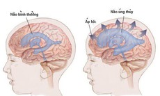 Câu hỏi thường gặp liên quan đến bệnh giãn não thất