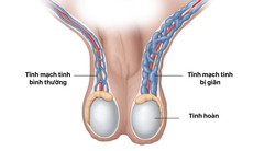 Câu hỏi thường gặp liên quan đến bệnh giãn tĩnh mạch thừng tinh