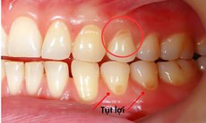 Tụt lợi điều trị được không và cách khắc phục