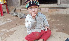 Bé 2 tuổi bị ung thư võng mạc, cha mẹ nghèo bán đàn lợn cũng không đủ tiền chữa trị