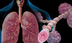 Khoảng 4 triệu người Việt mắc bệnh hen, gánh nặng bệnh tật không nhỏ